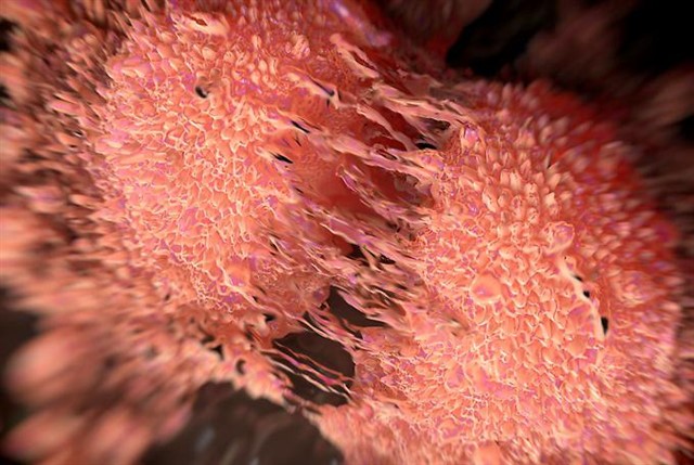  Nuovo test del sangue per identificare tumore prostata, evita 40% biopsie
