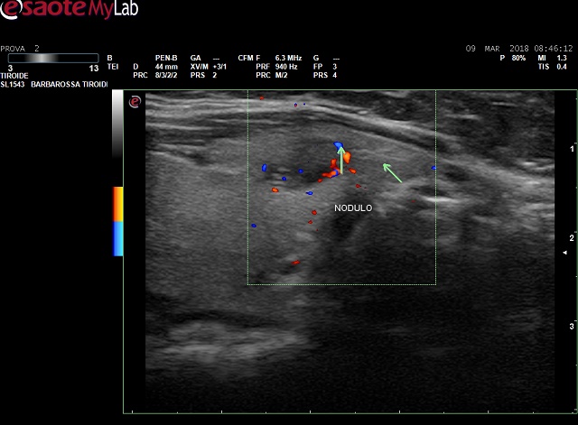 Referto di eco-tiroide che mostra un nodulo esaminato con il power-doppler