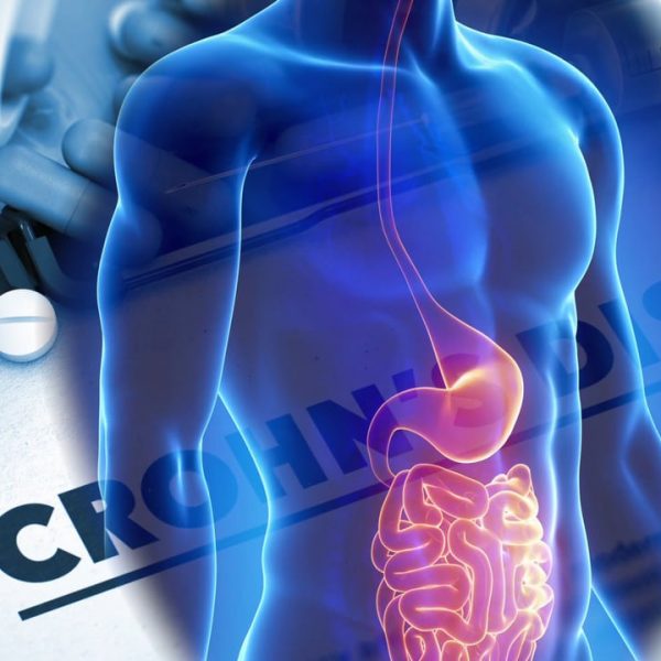 Il morbo di Crohn: una malattia autoimmune molto diffusa