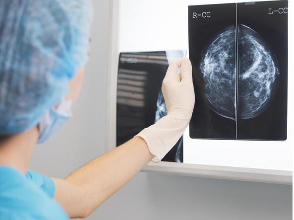 Tumore seno, nuovo test scopre le recidive in fase iniziale