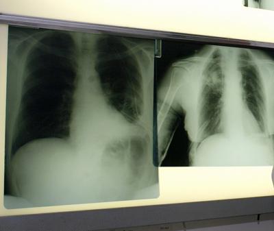 Malattie rare: da fibrosi polmonare idiopatica a sclerosi sistemica, con Covid più rischi